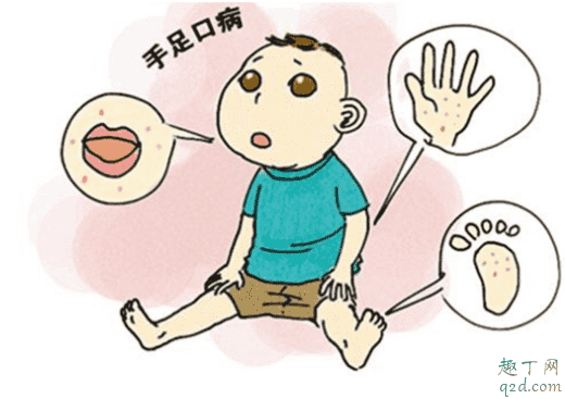 手足口疫苗打好還是不打好 接種手足口疫苗可以管多久1