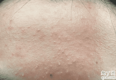 臉上有痤瘡可以喝蒲公英茶么 臉上長痘痘可以喝蒲公英水嗎4